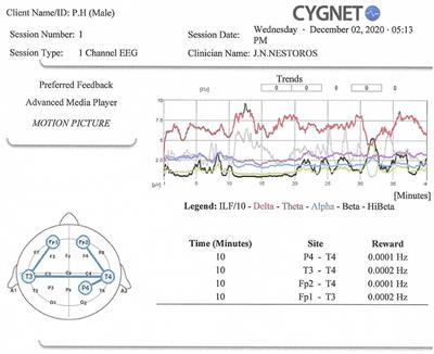 Infra-Low Frequency Neurofeedback rapidly ameliorates schizophrenia symptoms: A case report of the first session